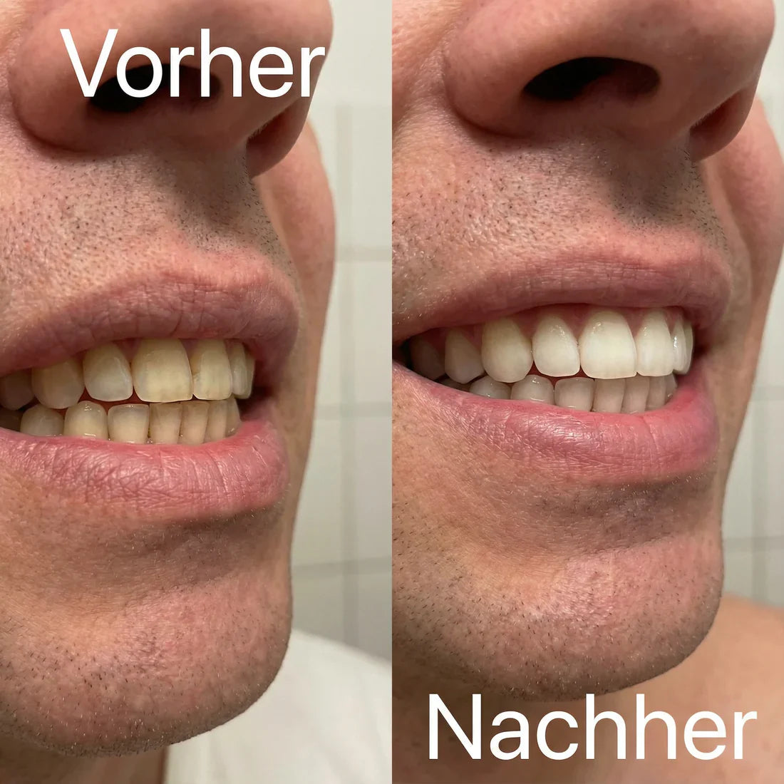 Vioren - Lila Zahnweiß-Streifen